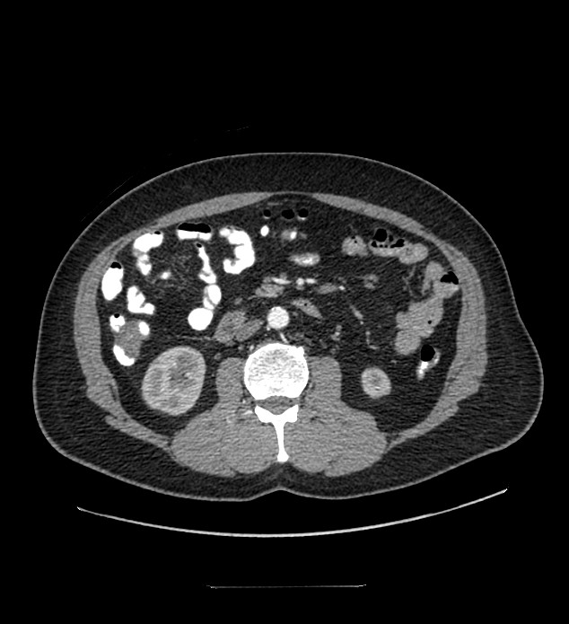 Chromophobe renal cell carcinoma (Radiopaedia 84337-99644 B 52).jpg