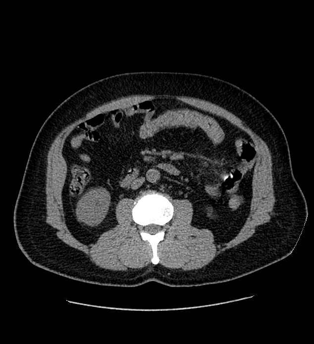 Chromophobe renal cell carcinoma (Radiopaedia 84337-99693 Axial non-contrast 67).jpg