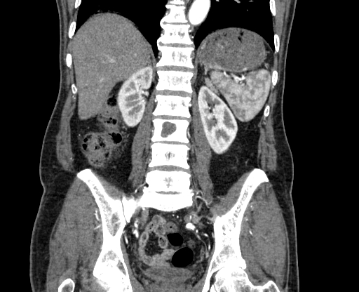 Chronic contained rupture of abdominal aortic aneurysm with extensive erosion of the vertebral bodies (Radiopaedia 55450-61901 D 54).jpg