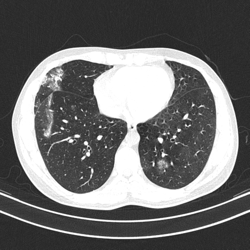 File:Chronic eosinophilic pneumonia (Radiopaedia 39331-41587 Axial lung window 37).png