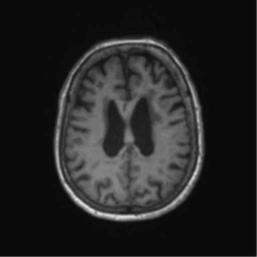 Chronic hypertensive encephalopathy (Radiopaedia 72844-83495 Axial T1 25).png