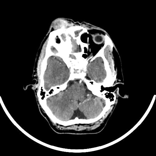 Chronic invasive fungal sinusitis with intraorbital and intracranial extension (Radiopaedia 56387-63046 B 110).jpg