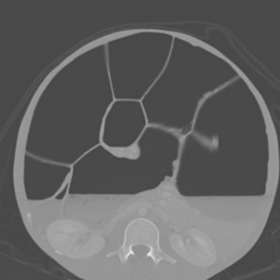 Chronic large bowel pseudo-obstruction (Radiopaedia 43181-46492 Axial bone window 87).jpg