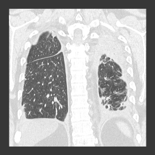 Chronic lung allograft dysfunction - restrictive form (Radiopaedia 60595-68316 Coronal lung window 75).jpg
