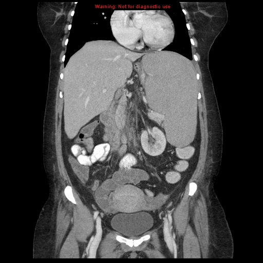 File:Chronic myeloid leukemia with splenic infarction (Radiopaedia 9178-9874 E 29).jpg