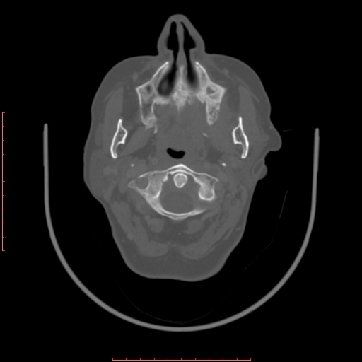 Chronic osteomyelitis - maxilla (Radiopaedia 23783-23927 Axial bone window 87).jpg