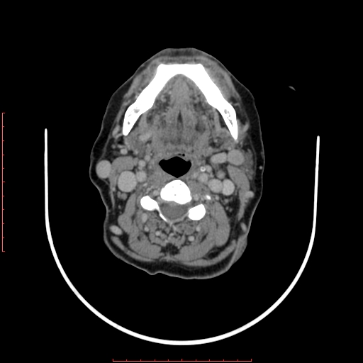 File:Chronic osteomyelitis - maxilla (Radiopaedia 23783-23927 B 13).jpg
