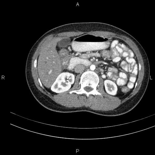 Chronic pancreatitis (Radiopaedia 64576-73450 B 68).jpg