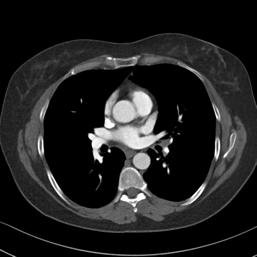 Chronic pulmonary embolus (Radiopaedia 39129-41341 Axial C+ CTPA 54).png