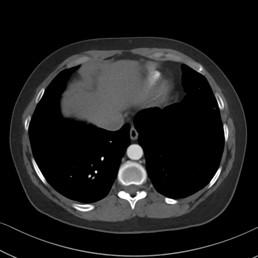 Chronic pulmonary embolus (Radiopaedia 39129-41341 Axial C+ CTPA 80).png