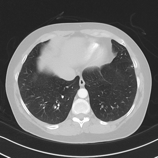 Chronic pulmonary embolus (Radiopaedia 39129-41341 Axial lung window 48).png