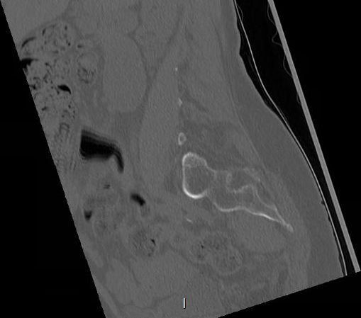 File:Chronic spinal hematoma with cauda equina syndrome (Radiopaedia 75745-88197 Sagittal bone window 3).png
