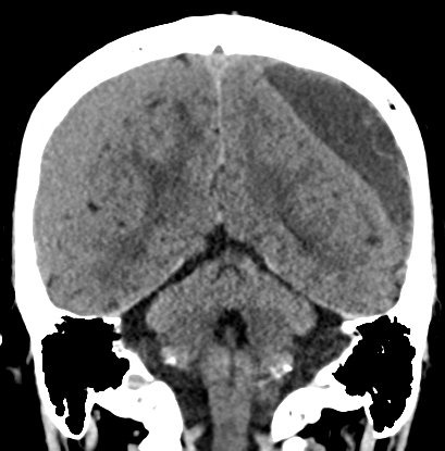 Chronic subdural hematomas (Radiopaedia 66577-75885 Coronal non-contrast 42).jpg