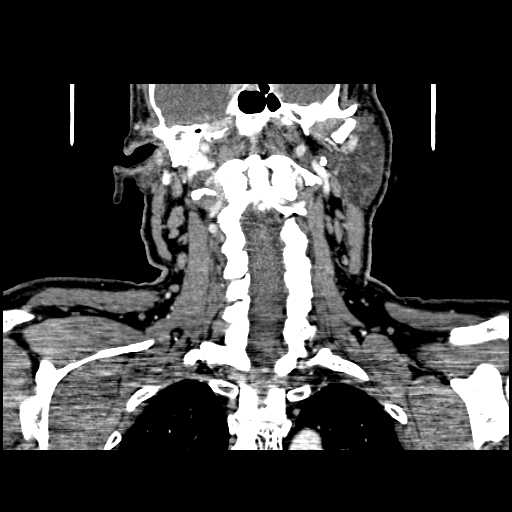 File:Chronic submandibular abscess (Radiopaedia 21738-21718 B 23).jpg