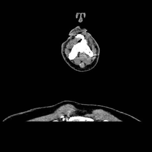 File:Chronic submandibular abscess (Radiopaedia 21738-21718 B 3).jpg