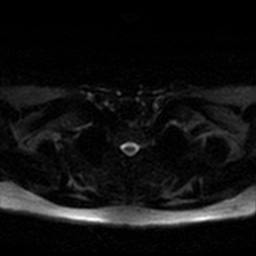 Chronic submandibular sialadenitis (Radiopaedia 61852-69885 Axial DWI 60).jpg