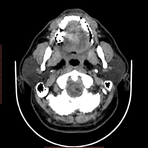 Chronic submandibular sialolithiasis (Radiopaedia 69817-79814 Axial non-contrast 53).jpg