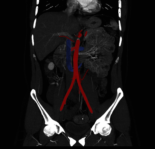 File:Circumaortic left renal vein (Radiopaedia 9069-9792 C 3).jpg