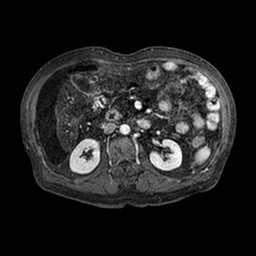 Cirrhosis and hepatocellular carcinoma in the setting of hemochromatosis (Radiopaedia 75394-86594 Axial T1 C+ fat sat 191).jpg