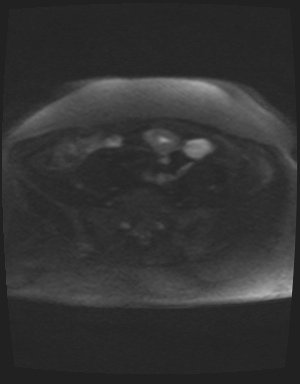 Class II Mullerian duct anomaly- unicornuate uterus with rudimentary horn and non-communicating cavity (Radiopaedia 39441-41755 Axial DWI 68).jpg
