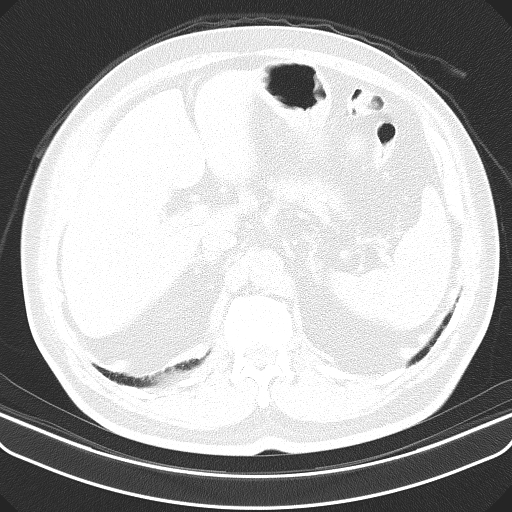 File:Classic complicated silicosis (Radiopaedia 49720-54961 Axial lung window 59).jpg