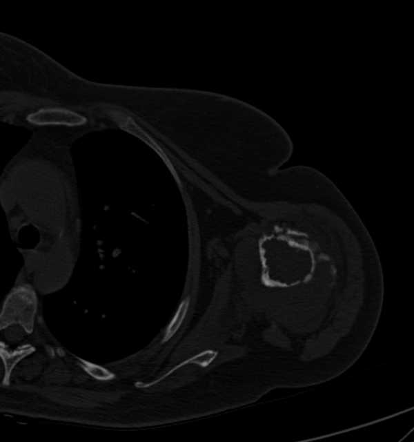 Clear cell chondrosarcoma - humerus (Radiopaedia 63104-71612 Axial bone window 60).jpg