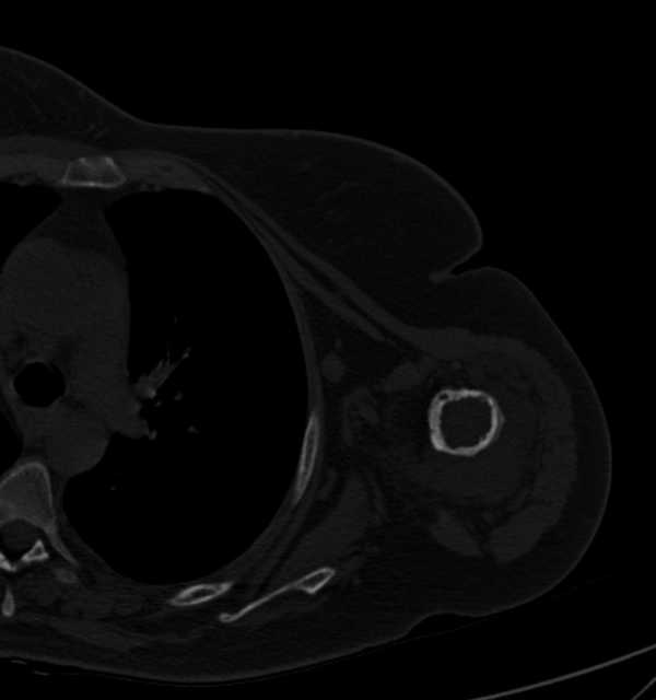 Clear cell chondrosarcoma - humerus (Radiopaedia 63104-71612 Axial bone window 65).jpg