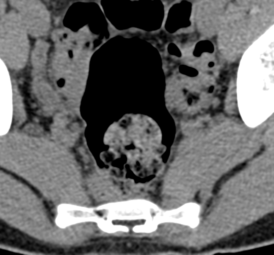 File:Clear cell meningoma - lumbar spine (Radiopaedia 60116-67691 Axial non-contrast 88).png