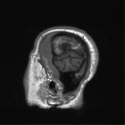 Clival chordoma invading the hypoglossal canal (Radiopaedia 48850-53887 Sagittal T1 85).png