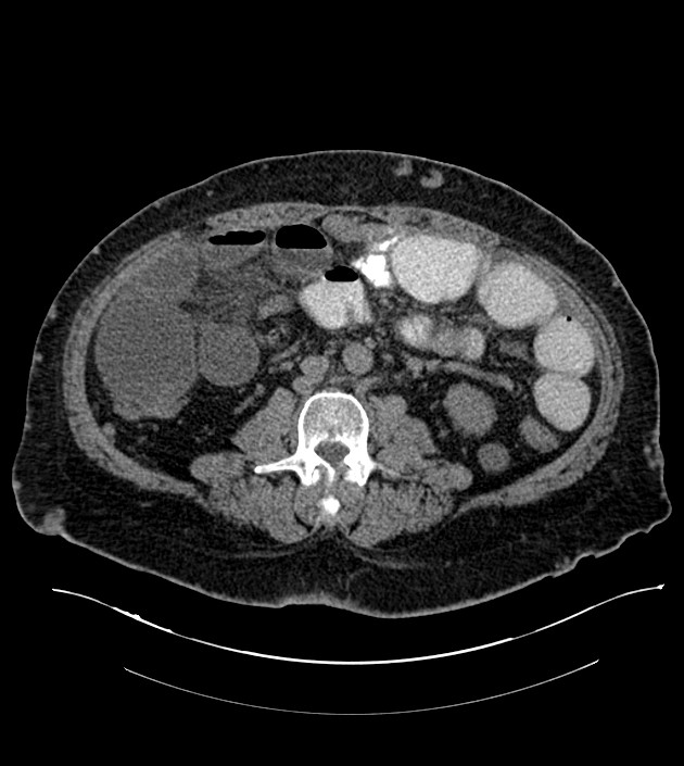 Closed-loop small bowel obstruction-internal hernia (Radiopaedia 78439-91096 Axial non-contrast 83).jpg