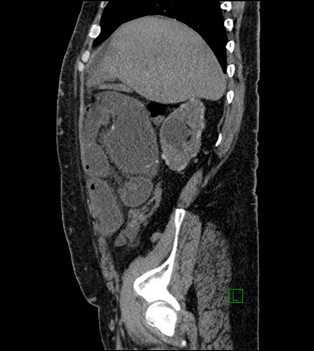 Closed-loop small bowel obstruction-internal hernia (Radiopaedia 78439-91096 C 108).jpg