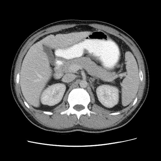 File:Closed-loop small bowel obstruction (Radiopaedia 73713-84509 A 56).jpg