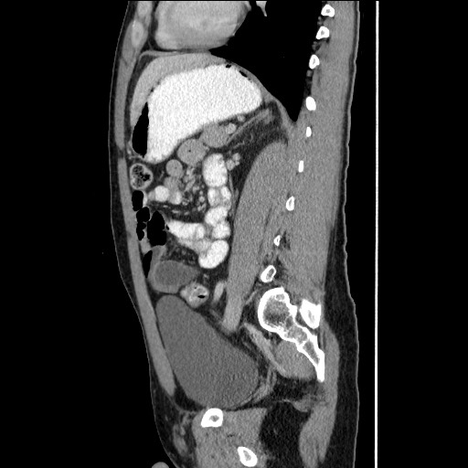File:Closed-loop small bowel obstruction (Radiopaedia 73713-84509 B 104).jpg
