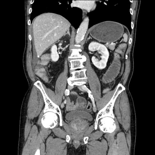 Closed loop obstruction due to adhesive band, resulting in small bowel ischemia and resection (Radiopaedia 83835-99023 E 75).jpg