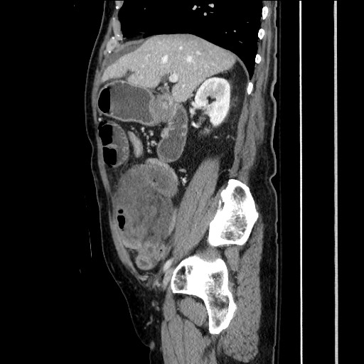 File:Closed loop obstruction due to adhesive band, resulting in small bowel ischemia and resection (Radiopaedia 83835-99023 F 69).jpg