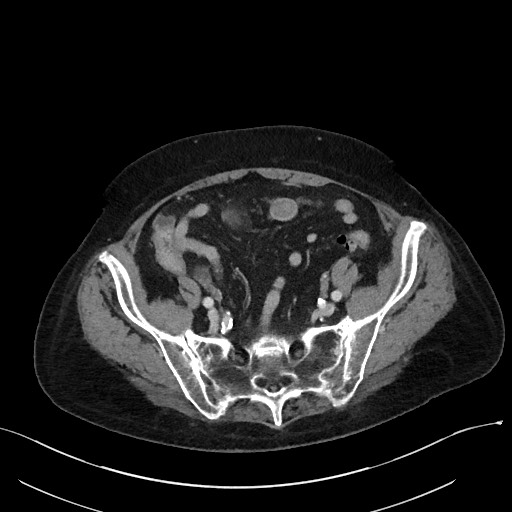 Closed loop small bowel obstruction - adhesions (Radiopaedia 59269-66611 A 99).jpg