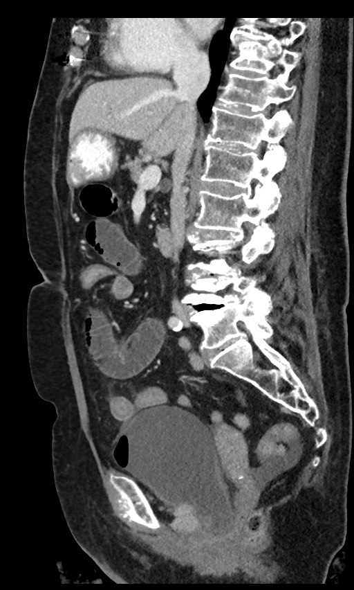 Closed loop small bowel obstruction - adhesions (Radiopaedia 59269-66611 C 62).jpg