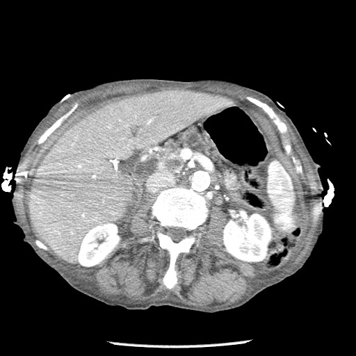 File:Closed loop small bowel obstruction - adhesions and infarct (Radiopaedia 85125-100678 B 38).jpg