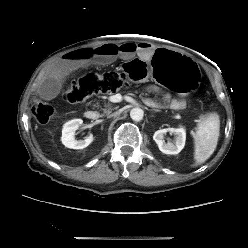 Closed loop small bowel obstruction - adhesive disease and hemorrhagic ischemia (Radiopaedia 86831-102990 A 78).jpg