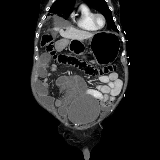 Closed loop small bowel obstruction - adhesive disease and hemorrhagic ischemia (Radiopaedia 86831-102990 B 40).jpg
