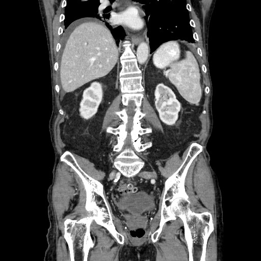 Closed loop small bowel obstruction - adhesive disease and hemorrhagic ischemia (Radiopaedia 86831-102990 B 86).jpg