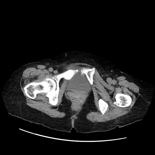 Closed loop small bowel obstruction due to adhesive band, with intramural hemorrhage and ischemia (Radiopaedia 83831-99017 Axial non-contrast 158).jpg