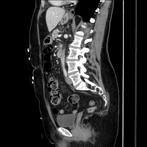 Closed loop small bowel obstruction due to adhesive bands - early and late images (Radiopaedia 83830-99014 C 102).jpg