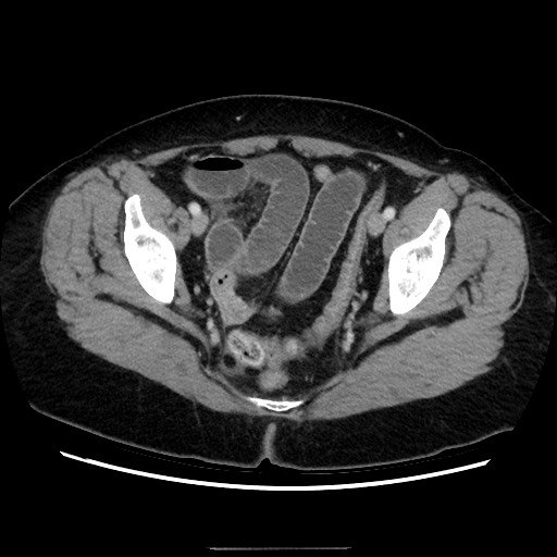 Closed loop small bowel obstruction due to adhesive bands - early and late images (Radiopaedia 83830-99015 A 146).jpg