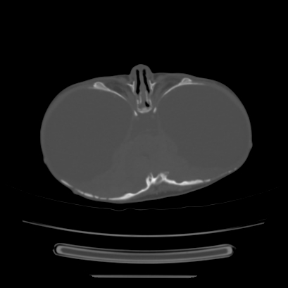 Cloverleaf skull (Radiopaedia 91901-109710 Axial bone window 63).jpg