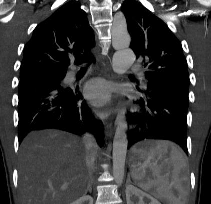 File:Coarctation of the aorta (Radiopaedia 9434-85453 Coronal 1).jpg