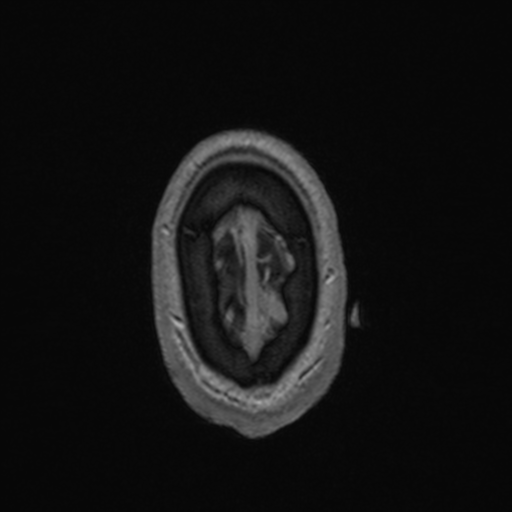 File:Colloid cyst (Radiopaedia 44510-48181 Axial T1 C+ 168).png