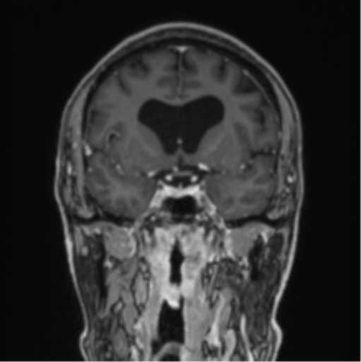 File:Colloid cyst of the third ventricle (Radiopaedia 86571-102662 Coronal T1 C+ 58).png