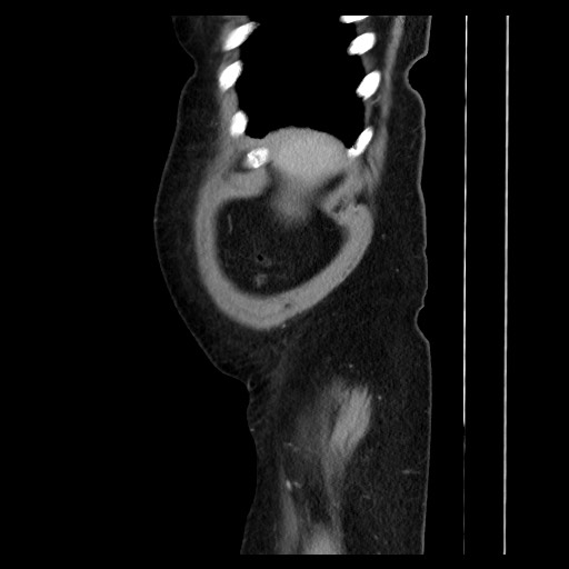 Colocolic intussusception due to tubular adenoma (Radiopaedia 73744-84551 C 28).jpg