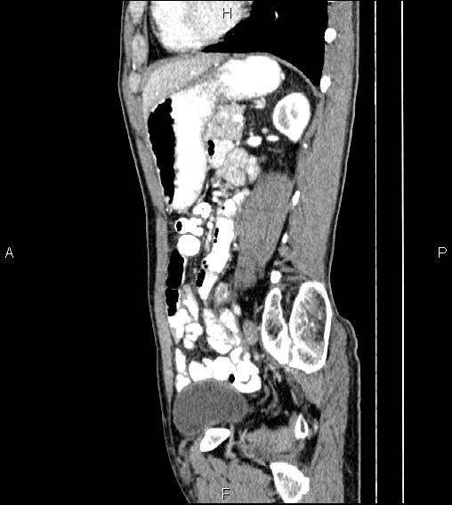 Colon adenocarcinoma - hepatic flexure (Radiopaedia 85635-101395 D 59).jpg